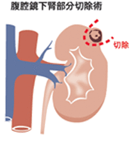 腹腔鏡下腎部切除術