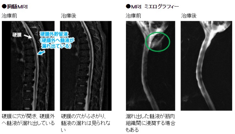 病気 髄 漏れる 液 が