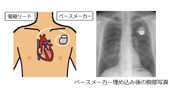 ペースメーカー を 入れる 病気