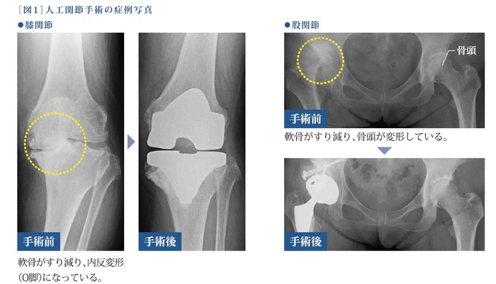 人工関節手術の症例写真