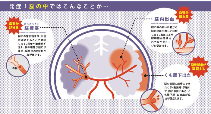 内出血 脳