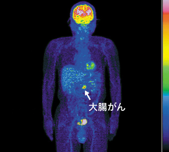 PET-CT画像