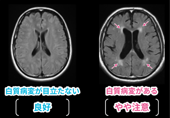 脳萎縮の比較MRI画像