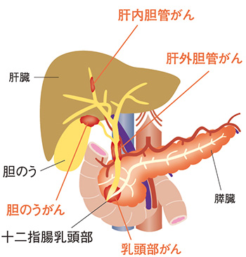 胆道がん