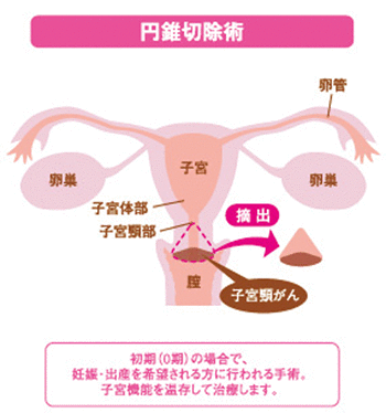 子宮頸がん 集学的がん診療センター 福井県済生会病院