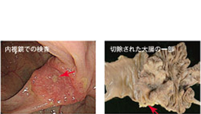 内視鏡での検査　切除された大腸の一部