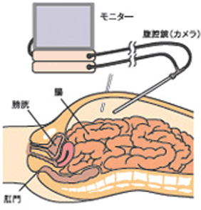 モニタ 腹腔鏡(カメラ)図