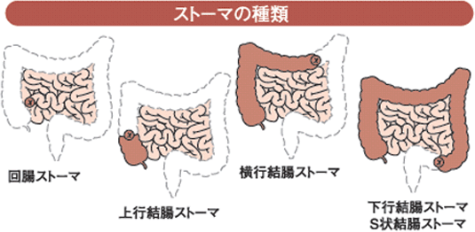 ストーマの種類