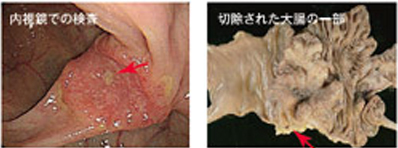 内視鏡での検査　切除された大腸の一部