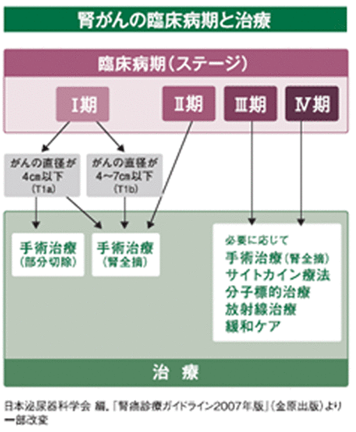 腎臓がんの臨床病期と治療