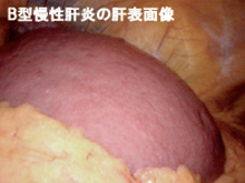 B型慢性肝炎の肝表画像