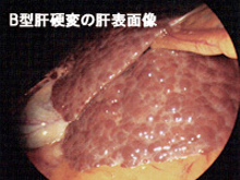 B型肝硬変の肝表画像