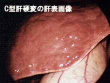 C型肝硬変の肝表画像