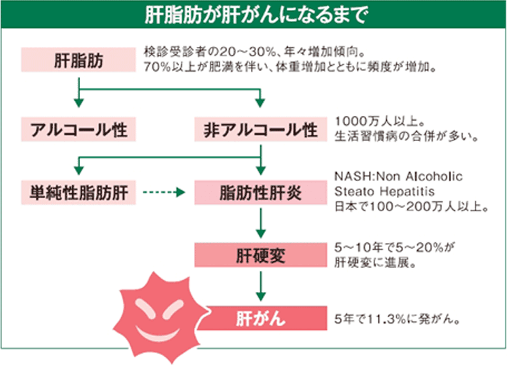 肝脂肪が肝がんになるまで