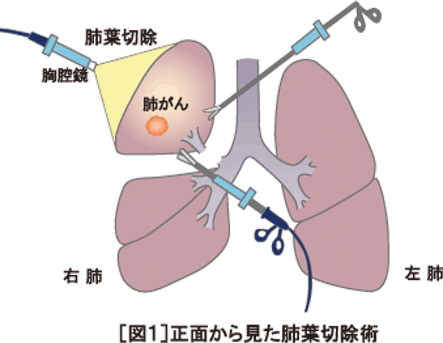 [図1]正面から見た肺葉切除術