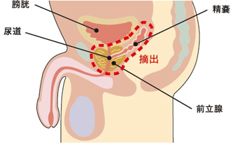 前立腺全摘徐術
