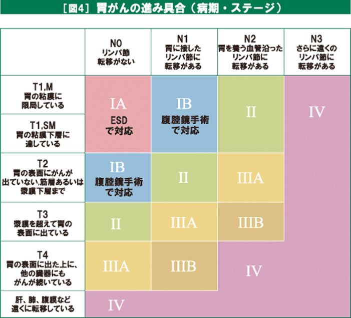 胃がんステージ4平均余命