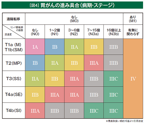 [図4]胃がんの進み具合(病気・ステージ)