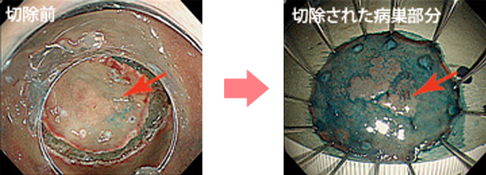 切除前→切除された病巣部分