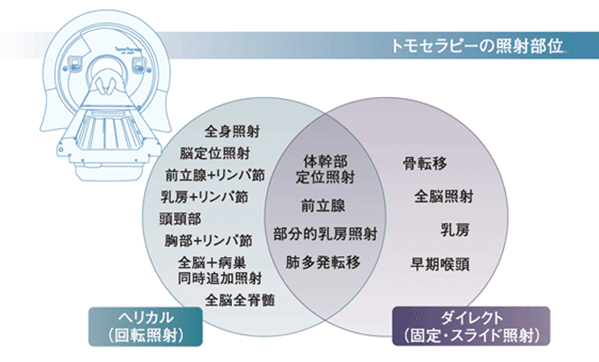 トモセラピーの照射部位