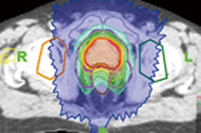 赤で示したのが前立腺がんの照射部分